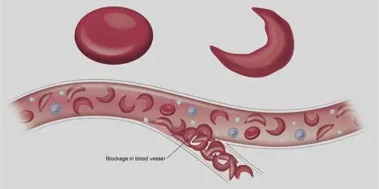 “I Was Diagnosed At 3 Months”, Sickle Cell Warrior Ekaya Duncan Shares Lifelong Battle With The Condition Ekaya Duncan’s Sickle Cell Journey: Diagnosis, Challenges And Life Story