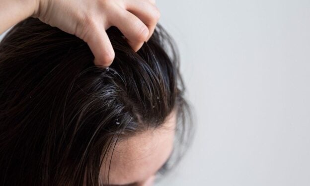 A Lady Struggling With An Itchy Scalp. Photo-File
