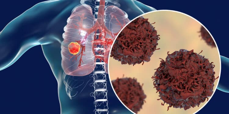 Study: Proteins Could Provide A New Treatment For Lung Cancer Image: Pfizer