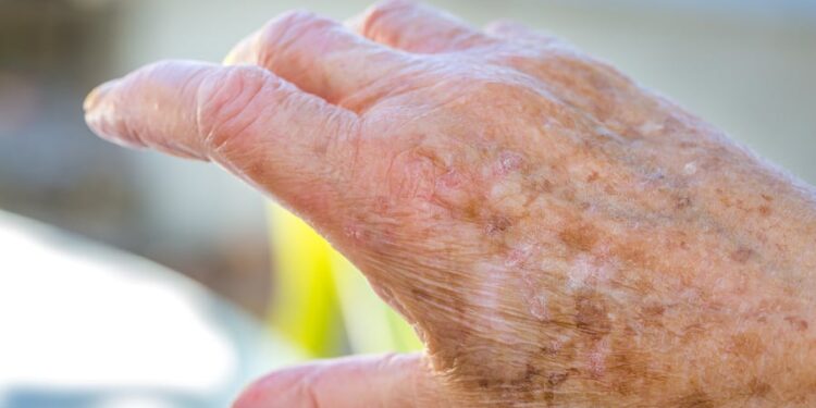 Eczema Changes With Age-Research

Photo Courtesy