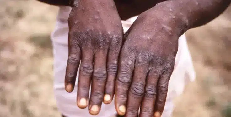 Mpox: Govt Issues Advisory After Disease Outbreak