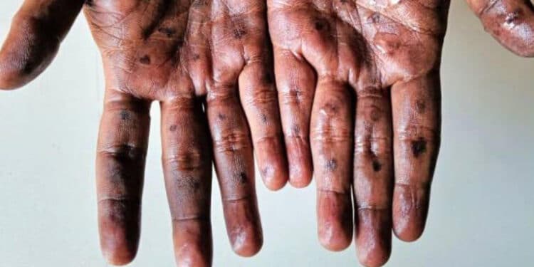 Mpox
