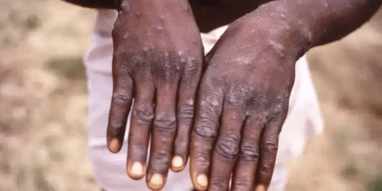 A Person With Rashes On The Skin, A Symptom Of The Mpox Virus. Photo/Courtesy