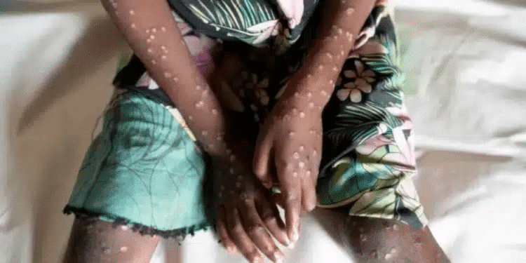 Understanding How Mpox Spreads, Symptoms, And How To Prevent