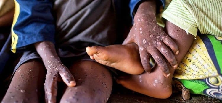 Africa To Receive First Batch Of Mpox Vaccines After Criticism Over Delays Mpox: First Batch Of Vaccines Arrive Set To Arrive In Africa