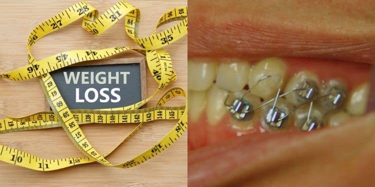 A Collage Of A Photo Representing Weight Loss And A Jaw Wired Dental Formula.