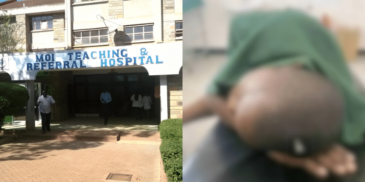 Mtrh Clarifies Case Of Boy With Nail Stuck In His Head